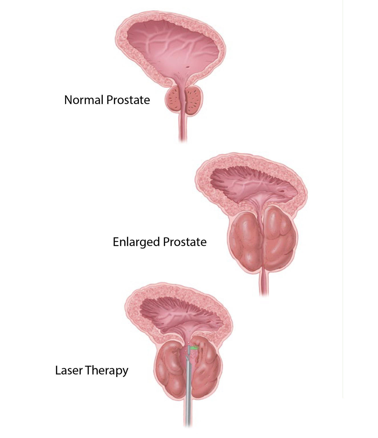 enlarged-prostate-treatment-laser-therapy-healthtronics